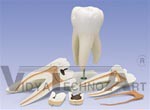 Giant Molar with Dental Caries, 15 times life-size, 6 part